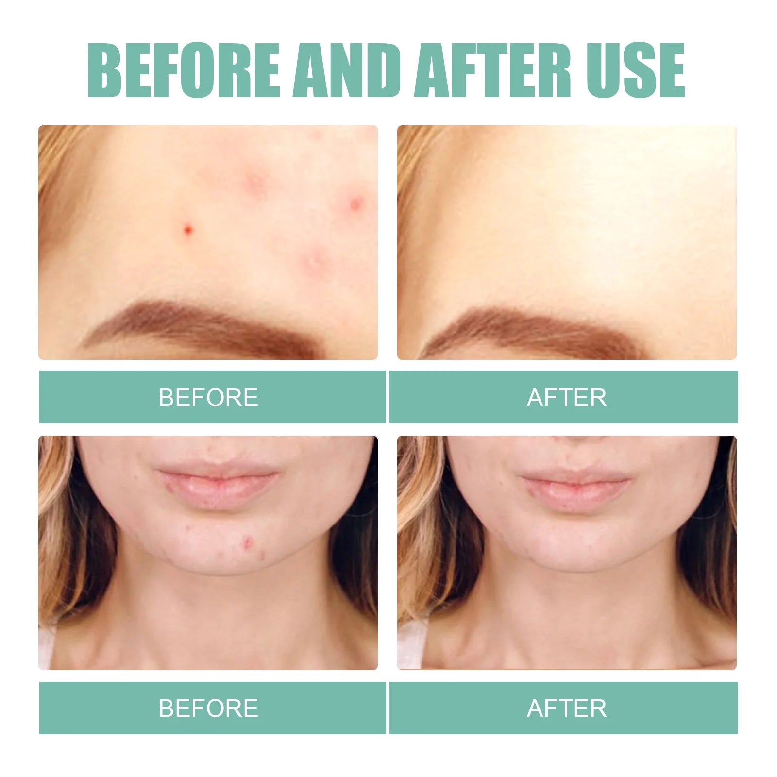 EELHOE Full Face Acne Relief Patch