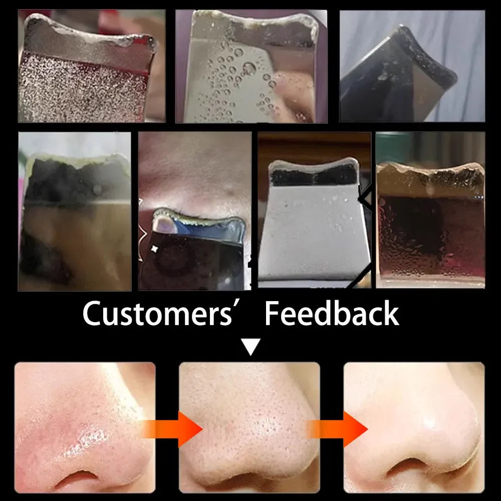 Skin Scrubber Blackhead Remover Tool
