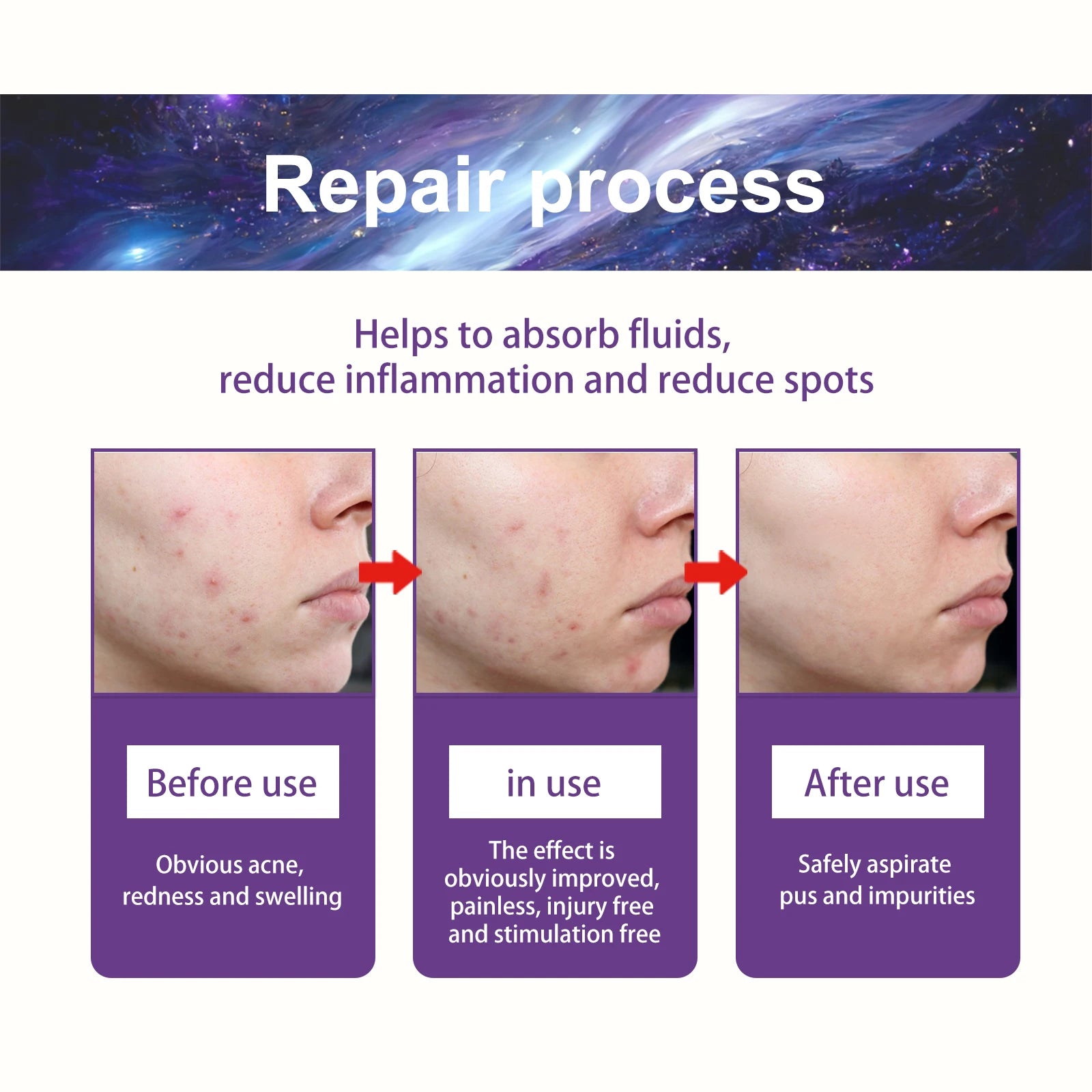 180Pcs Water Gel Acne Patch Set